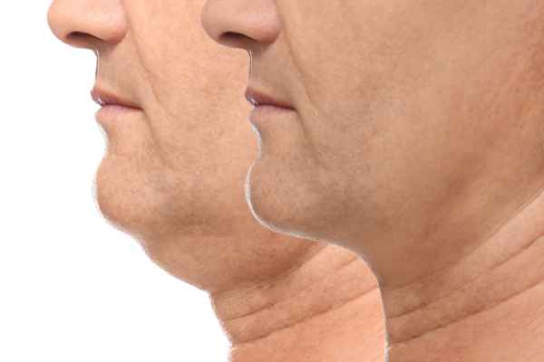 HIFU - Breakthrough in Anti - ageing 2 hifu results Bridport
