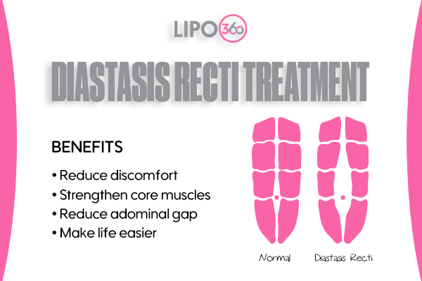 Revolutionising Muscle Repair: The Power of LIPO360 Body Sculpt Post-Injury 5 diastasis recti treatment Bridport
