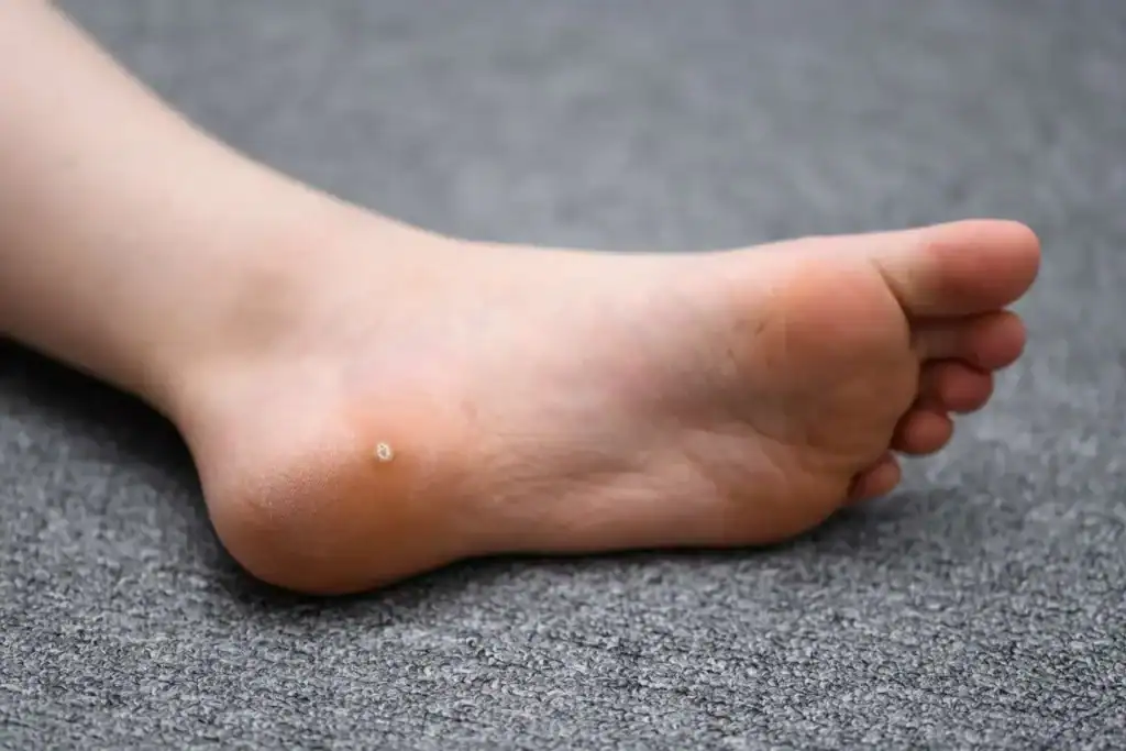 Cryotherapy For Warts And Also Verrucas 2 Image of verruca on the bottom of the foot that able to be treated with Cryotherapy Bridport