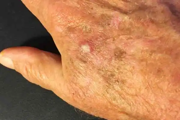 Image of Actinic keratoses Bridport on a person hand
