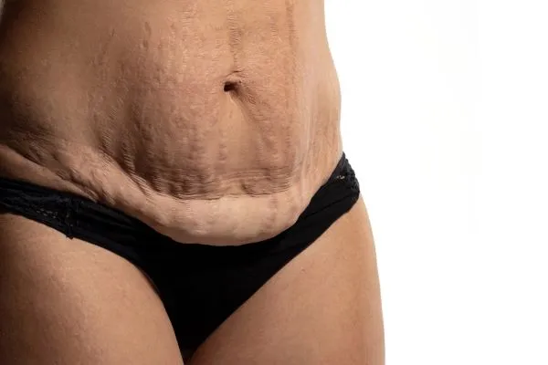 The science behind skin tightening Bridport picture of a woman's sagging skin on the stomach